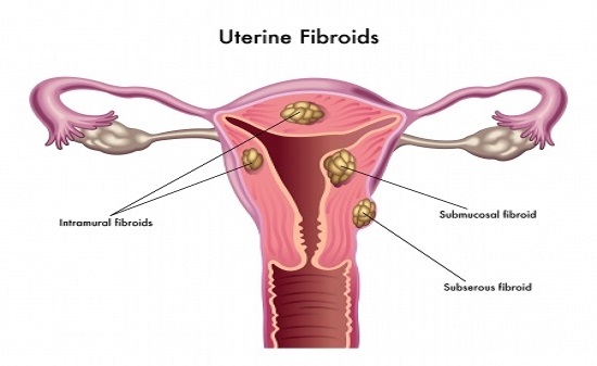 Fibroid Reduction Supplements – A Comprehensive Guide to Natural Support