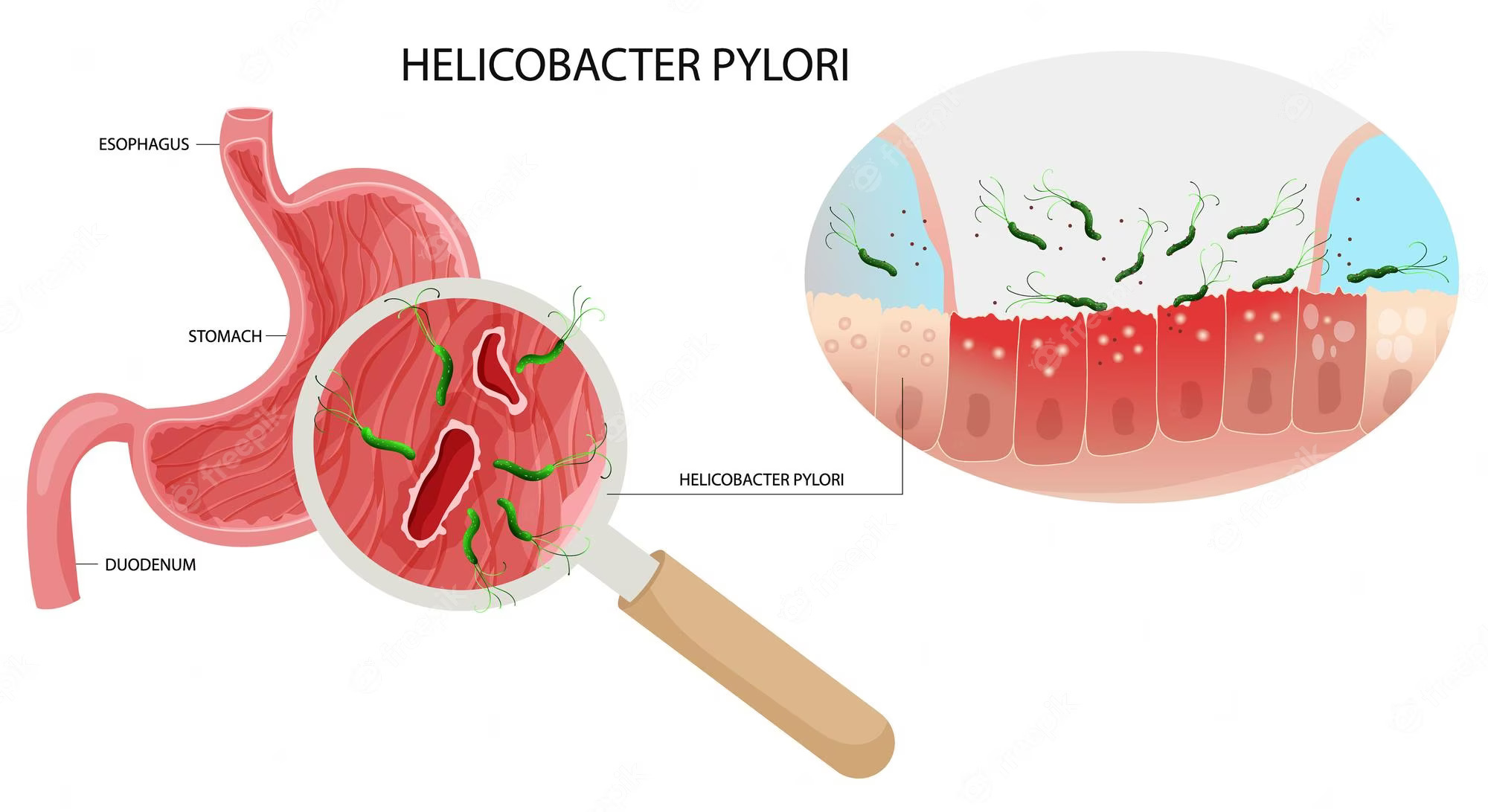 Helicobacter Pylori Infection Treatment