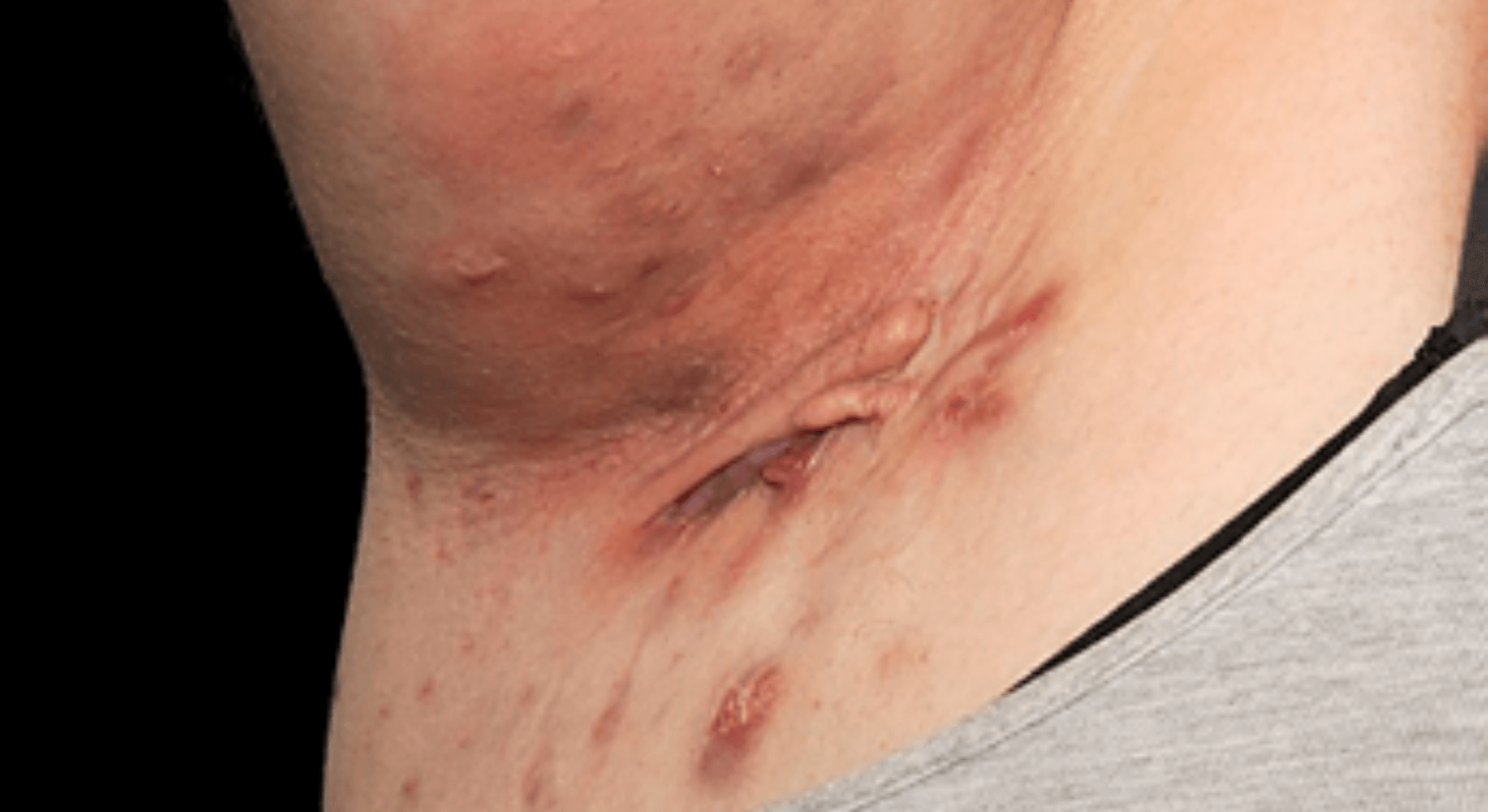 HC Hidradenitis Suppurativa – Symptoms and Causes