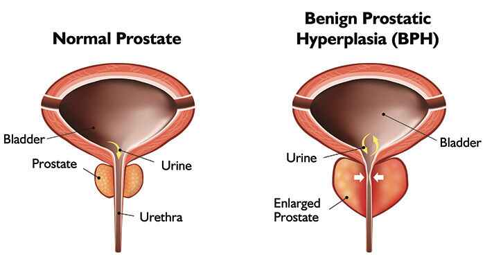 A Comprehensive Guide to Benign Prostate Hyperplasia (BPH) Treatment